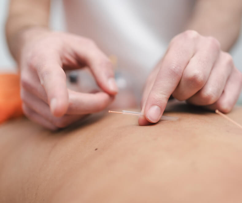 Patient undergoing dry needling therapy on back.
