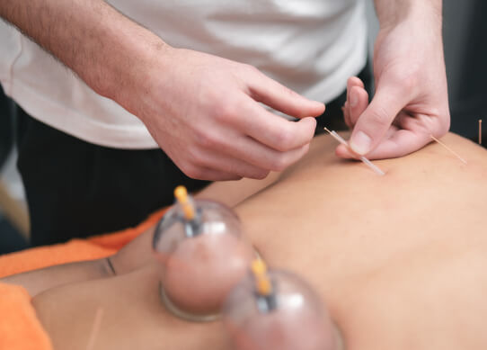 Patient receiving dry needling and cupping therapy on their back.